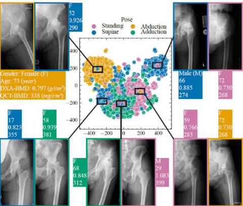 【プレスリリース】人工知能でX線画像から骨密度を高精度に計測 ～骨粗鬆症診断をどこの病院でも簡便・正確に実現～ 超高齢社会の医療コストの大幅削減も可能に